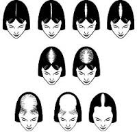 alopecia_woman.jpg